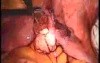 Laparoscopic Management Of Paraovarian Cyst