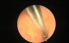 Cannulation of Proximal Tubal Blockage
