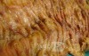 Toxic Dilatation of the Colon Superimposed pseudomembranous colitis involving the
 right colon (15 of 17)