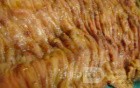 Toxic Dilatation of the Colon Superimposed pseudomembranous colitis involving the
 right colon (15 of 17)