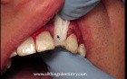 Temporary Bridge Using Denture Tooth And Ribbond
