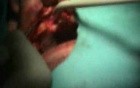 Autogenous Bone Grafting Within Oral Cavity
