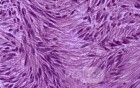 Jejunal Gastrointestinal Stromal tumor (GIST) (12 of 86)