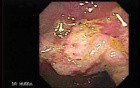 Cap polyposis that resemble a adenocarcinoma of the rectum (2 of 7)