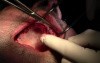 Suturing Technique - Implant Surgery, #10-11-12-13 Sites