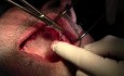 Suturing Technique - Implant Surgery, #10-11-12-13 Sites