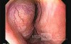 Gastrointestinal Stromal Tumors - Esophageal GIST