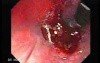 Tubulo - Villous Rectal Adenoma - Endoscopy (7 of 35)