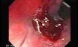 Tubulo - Villous Rectal Adenoma - Endoscopy (7 of 35)