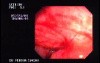 Ulcerated Rectum Adenocarcinoma
