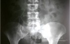 Nephrolithiasis Sinistra