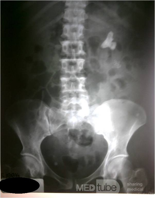 Nephrolithiasis Sinistra