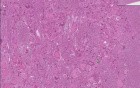 Arteriovenous malformation
