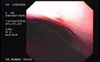 Hemorrhage Due Status Post Rubber Band Ligation of Esophageal Varices - Bleeding from the Varix