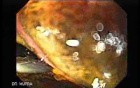 Endoscopic view of Barrett Esophagus -jumbo forceps biopsy (7 of 9)