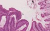 Tubular adenoma - Histopathology - Colon