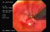 Flexible Endoscopic Suturing - Performing the Knot
