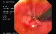 Flexible Endoscopic Suturing - Performing the Knot