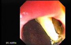 Migration Of Intragastric Balloon