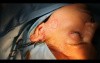 Scarless Mid face lift 
