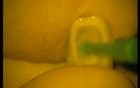 Best Way To Fix Crown - Adhesive Cementation (1/2)