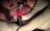 Implant Placement #9 - Screwline Promote Plus, Full Video