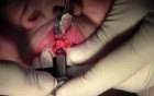 Implant Placement #9 - Screwline Promote Plus, Full Video