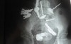 Multiple Foreign bodies in the GI tract (11 of 12)