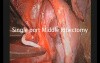 Single Port VATS Lobetomy Using Vascular Clips