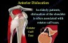 Shoulder Dislocations - Conditions and Treatment