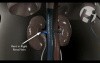 Retroperitoneal Bleed from the Right Kidney