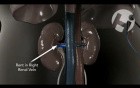 Retroperitoneal Bleed from the Right Kidney