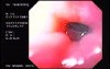 Banding of Esophageal Varices - Ligation of Varices