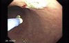 Multiple Gastric Angiodysplasia (1 of 17)