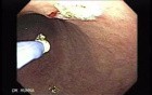 Multiple Gastric Angiodysplasia (1 of 17)