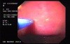 Gastric Angiodysplastic Lesions - Argon Plasma Coagulation (3 of 3)
