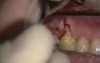 Lateral Sliding Flap 