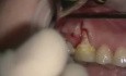 Lateral Sliding Flap 