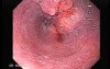 Esophageal Squamous Cell Carcinoma (2 of 3 )