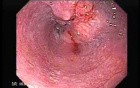Esophageal Squamous Cell Carcinoma (2 of 3 )