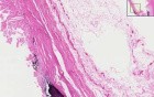 Aorta - Atherosclerosis 2