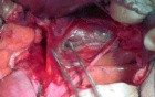 Anatomy of the Pelvis with Surgical Assessment (for Radical Hysterectomy) - Three Posterior Avascular Spaces
