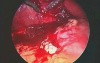 Laparoscopic Cholecystectomy