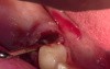 Extraction #29 Root Tip With Simple Socket Bone Grafting