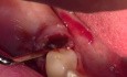 Extraction #29 Root Tip With Simple Socket Bone Grafting