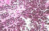 Small cell carcinoma of the lung that invades the upper and
 the middle third of the Esophagus (6 of 7)