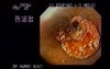 Esophageal Squamous Cell Carcinoma - case 2