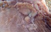 Early Gastric Cancer (14 of 21)