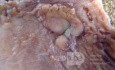 Early Gastric Cancer (14 of 21)