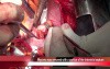 Left Atrial Myxoma Resection